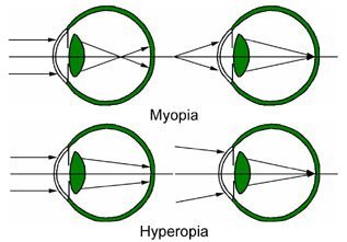 myopia and hyperopia diagram